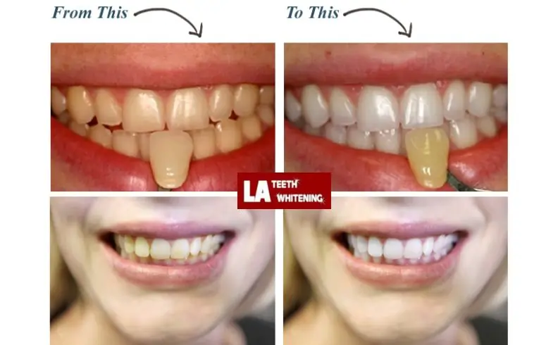 Is Laser Whitening More Expensive Than Standard Whitening—And Is It Worth It Huntingdon