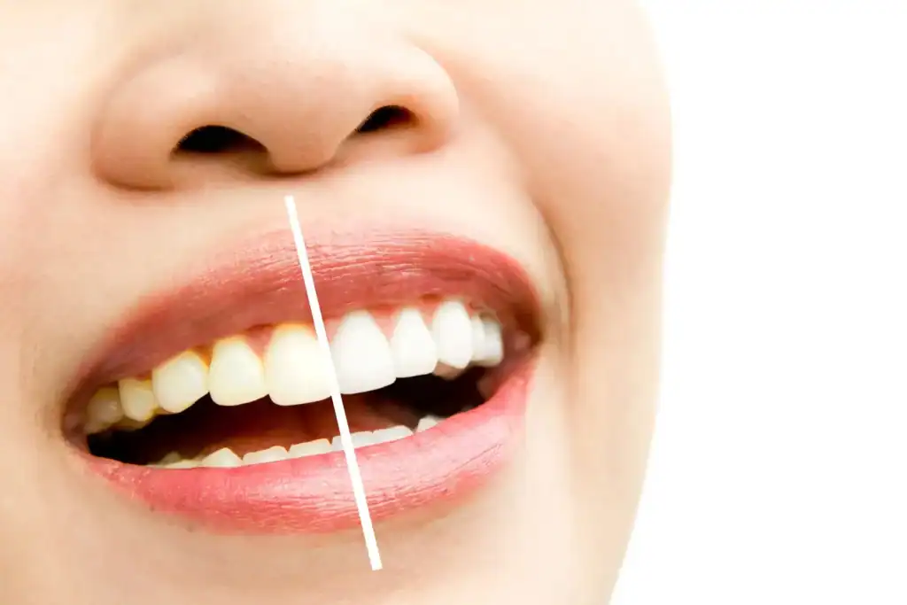 What’s the Difference Between Standard and Laser Teeth Whitening Huntingdon
